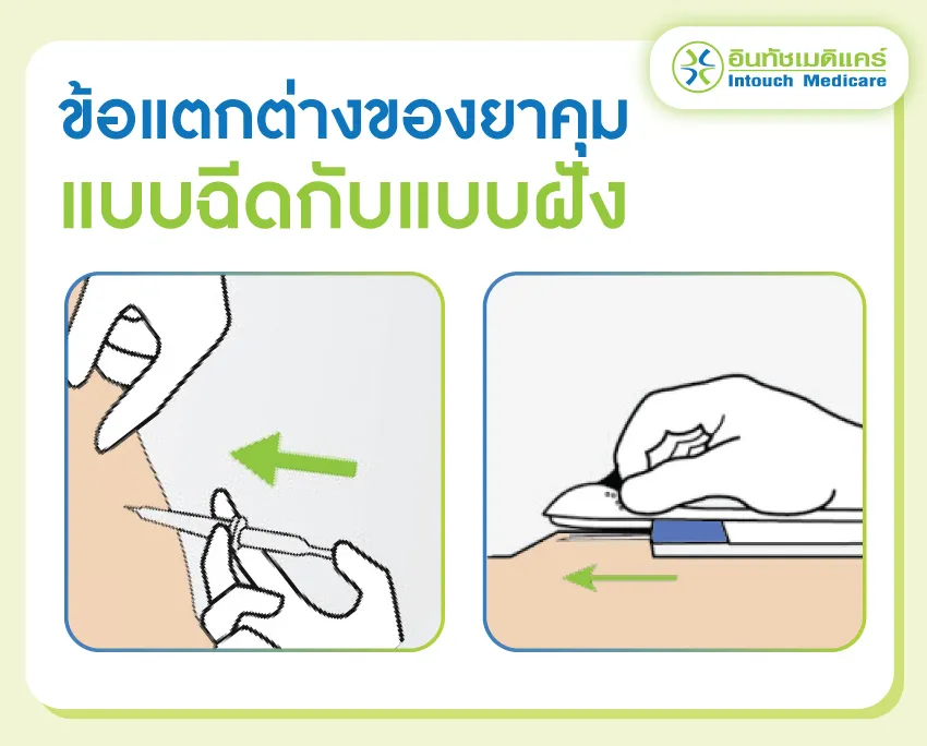 ข้อแตกต่างของยาคุมแบบฉีดกับฝังยาคม