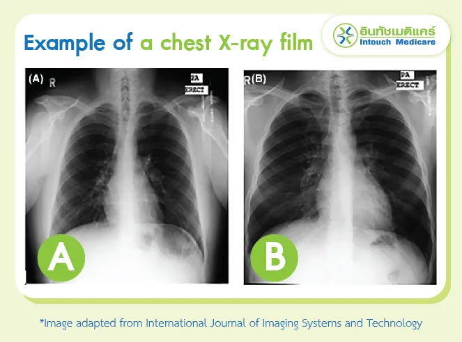 Example of a chest X-ray film.