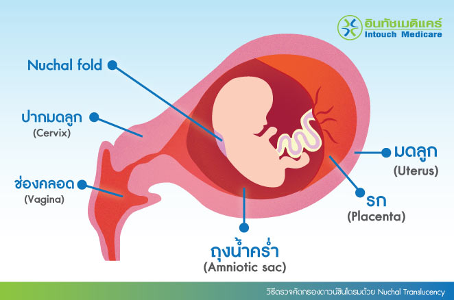 วิธีตรวจคัดกรองดาวน์ซินโดรมด้วย Nuchal Translucency