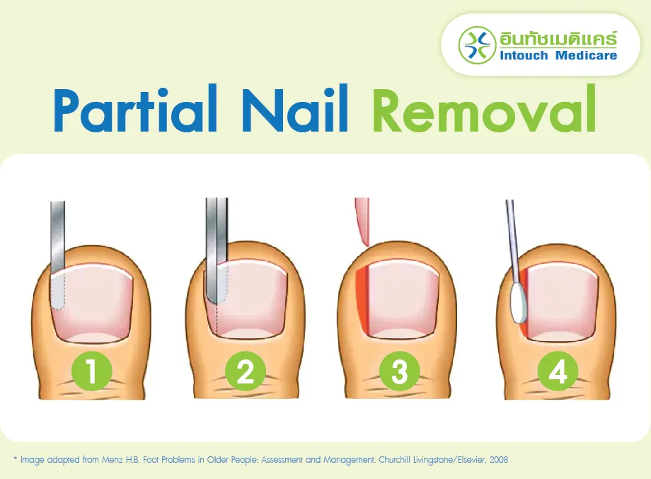 Partial Nail Removal