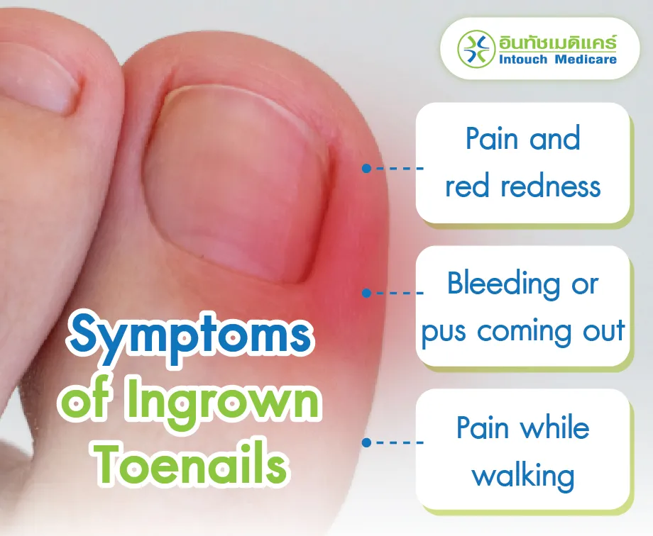 Symptoms of Ingrown Toenails.