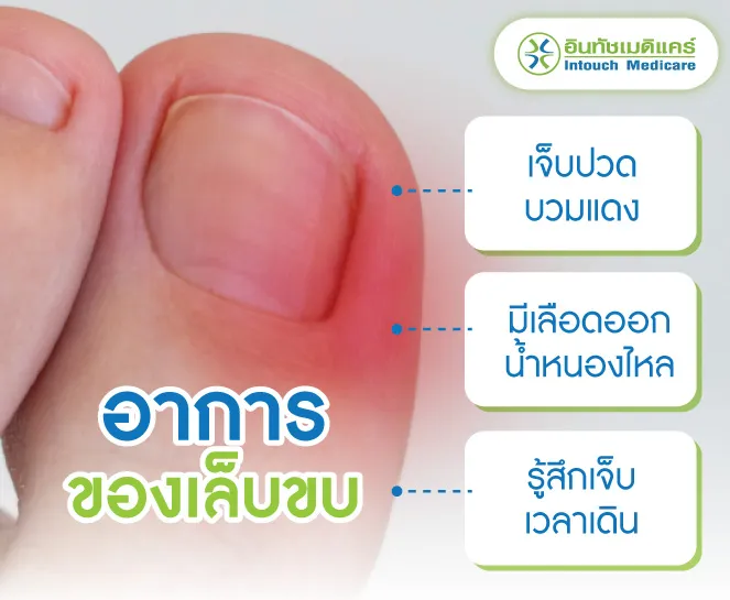 อาการของเล็บขบ