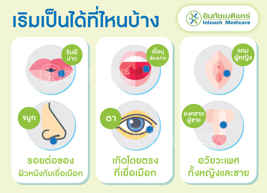 โรคเริมเป็นได้ที่ไหนบ้าง