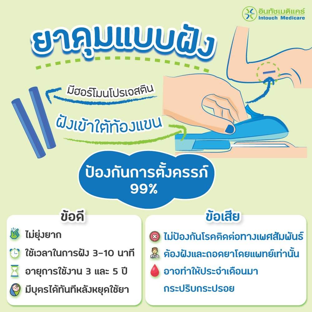 ยาคุมแบบฝัง ข้อดี ข้อเสีย