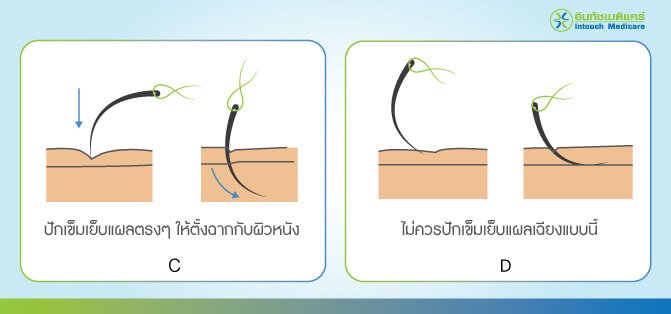 การปักเข็มเย็บแผล