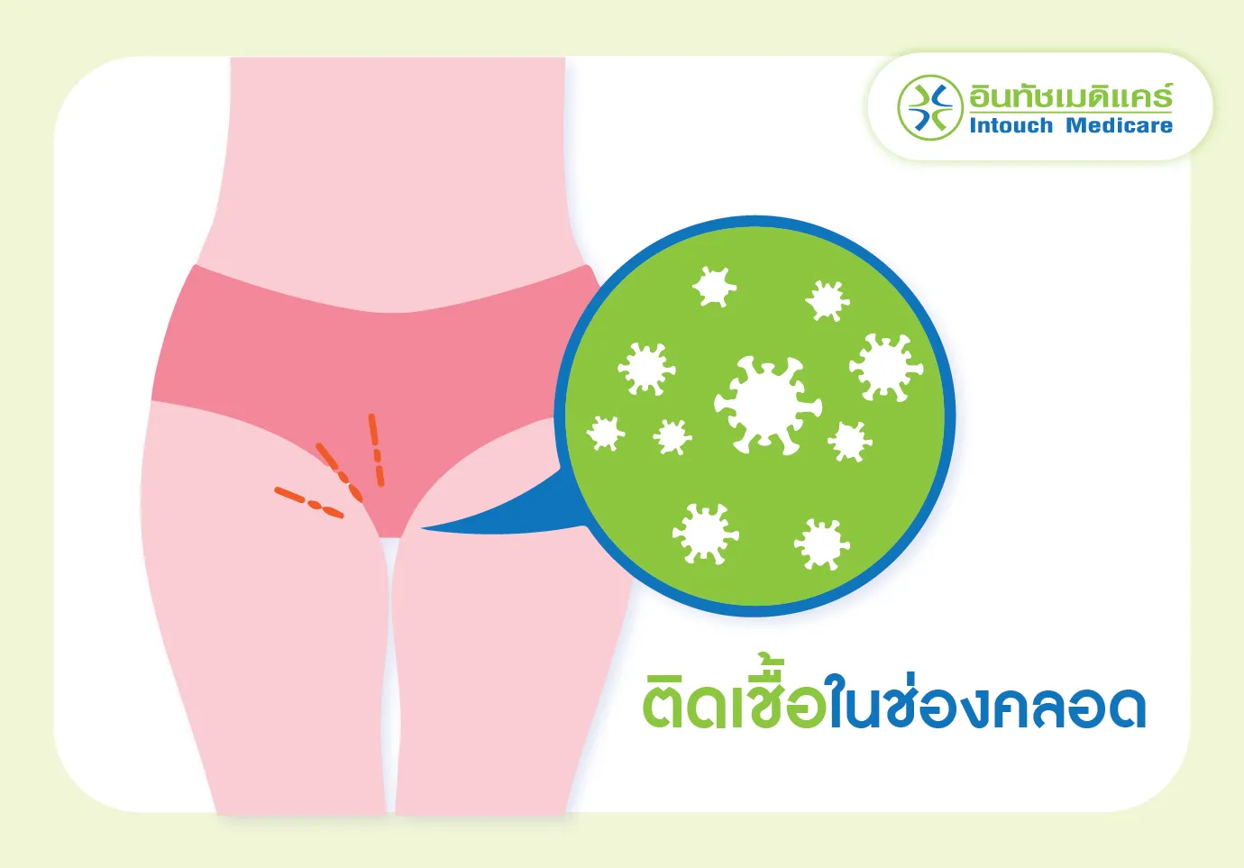 ติดเชื้อในช่องคลอด จากการใส่กางเกงในซ้ำ