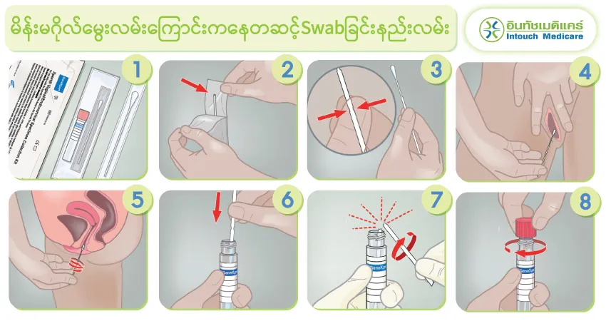 မိန်းမဂိုလ်မွေးလမ်းကြောင်းကနေတဆင့်Swabခြင်းနည်းလမ်း